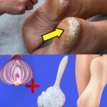 Remedios Caseros Efectivos para Tratar Talones Secos y Agrietados