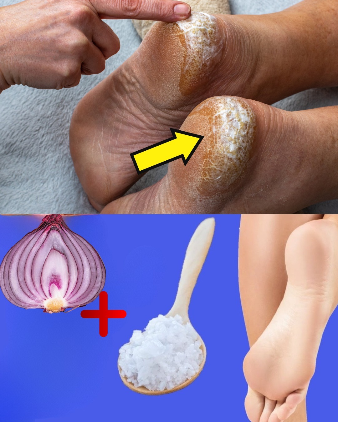 Remedio Casero para Talones Agrietados