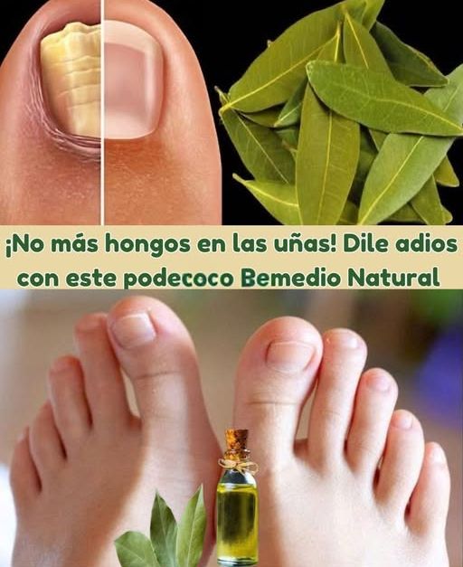 Remedio natural para hongos